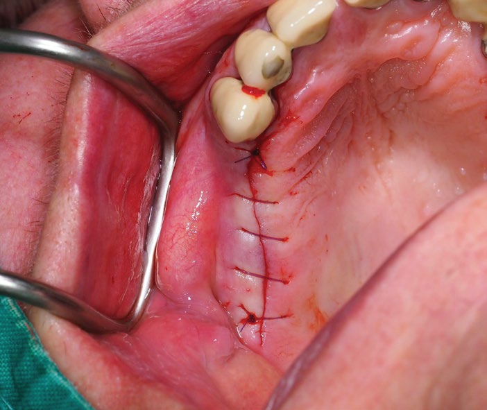 Phục hình cầu răng sứ trên Implant cho ca mất 3 răng liên tiếp